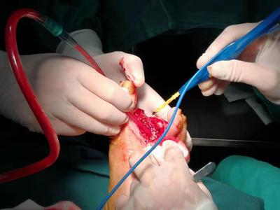 糖尿病并发症患者的福音——骨科成功运用vsd技术治疗糖尿病足并发